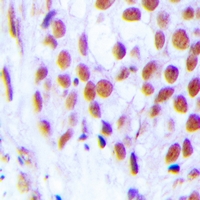 Immunohistochemical analysis of FOG2 staining in human breast cancer formalin fixed paraffin embedded tissue section. The section was pre-treated using heat mediated antigen retrieval with sodium citrate buffer (pH 6.0). The section was then incubated with the antibody at room temperature and detected using an HRP conjugacompact polymer system. DAB was used as the chromogen. The section was then counterstained with haematoxylin and mounted with DPX.