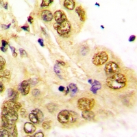 Immunohistochemical analysis of GATA5 staining in human lung cancer formalin fixed paraffin embedded tissue section. The section was pre-treated using heat mediated antigen retrieval with sodium citrate buffer (pH 6.0). The section was then incubated with the antibody at room temperature and detected using an HRP conjugacompact polymer system. DAB was used as the chromogen. The section was then counterstained with haematoxylin and mounted with DPX.