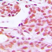 Immunohistochemical analysis of HOXD12 staining in human breast cancer formalin fixed paraffin embedded tissue section. The section was pre-treated using heat mediated antigen retrieval with sodium citrate buffer (pH 6.0). The section was then incubated with the antibody at room temperature and detected using an HRP conjugated compact polymer system. DAB was used as the chromogen. The section was then counterstained with haematoxylin and mounted with DPX.