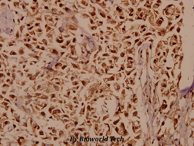 Immunohistochemistry (IHC) analyzes of XRCC3 (Q67) pAb in paraffin-embedded human breast carcinoma tissue at 1:50.