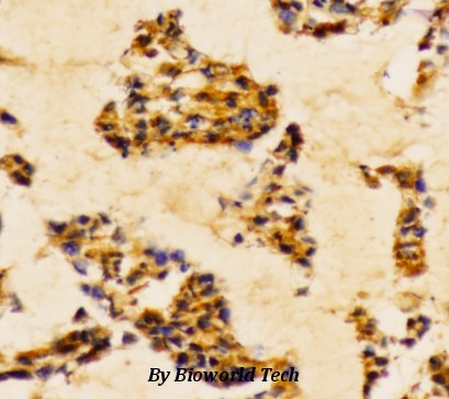 Immunohistochemistry (IHC) analysis of PI3K p85α (Y467)/p55γ (Y199) pAb in paraffin-embedded human breast carcinoma tissue