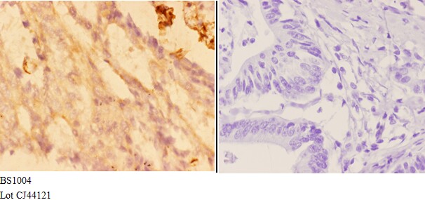 Immunohistochemistry (IHC) analyzes of Actin-α3/γ2 (E2) pAb in paraffin-embedded human colon carcinoma tissue at 1:50,showing cytoplasmic and nucleus staining.Negative control (the right)Using PBS instead of primary antibody, secondary antibody is Goat Anti-Rabbit IgG-biotin followed by avidin-peroxidase.