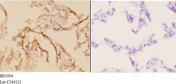 Immunohistochemistry (IHC) analyzes of Actin-α3/γ2 (E2) pAb in paraffin-embedded human lung carcinoma tissue at 1:50,showing cytoplasmic and nucleus staining.Negative control (the right)Using PBS instead of primary antibody, secondary antibody is Goat Ant