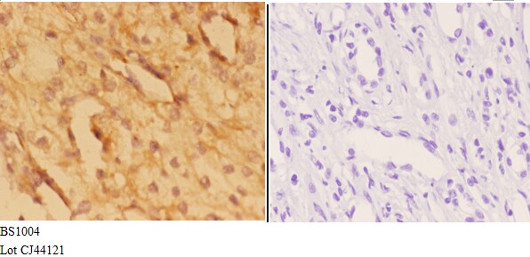 Immunohistochemistry (IHC) analyzes of Actin-α3/γ2 (E2) pAb in paraffin-embedded human kidney carcinoma tissue at 1:50,showing cytoplasmic and nucleus staining.Negative control (the right)Using PBS instead of primary antibody, secondary antibody is Goat A