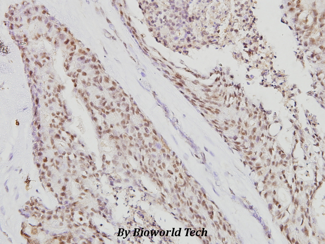 Immunohistochemistry (IHC) analyzes of TFAP2A (K431) pAb in paraffin-embedded human breast carcinoma tissue at 1:100.