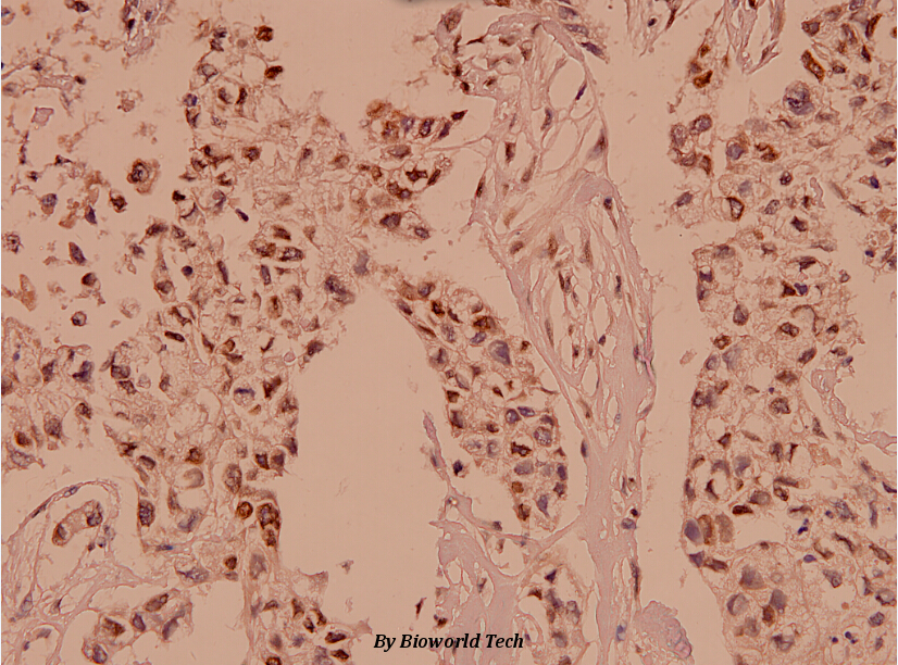 Immunohistochemistry (IHC) analyzes of APC (Q2829) pAb in paraffin-embedded human breast carcinoma tissue at 1:100.