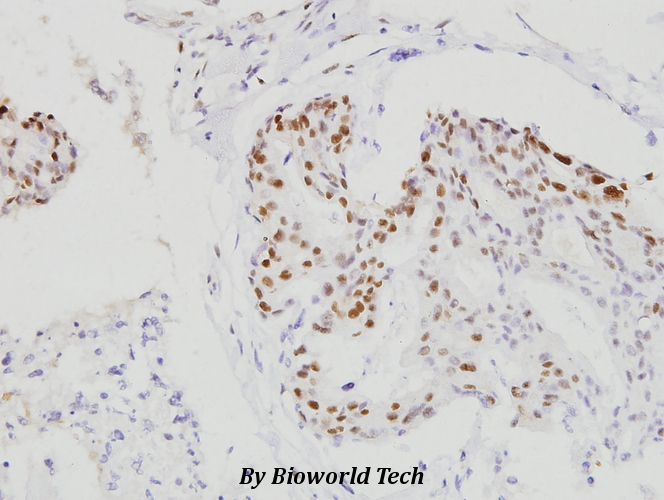 Immunohistochemistry (IHC) analyzes of C/EBP-β (S229/182) pAb in paraffin-embedded human breast carcinoma tissue at 1:100.