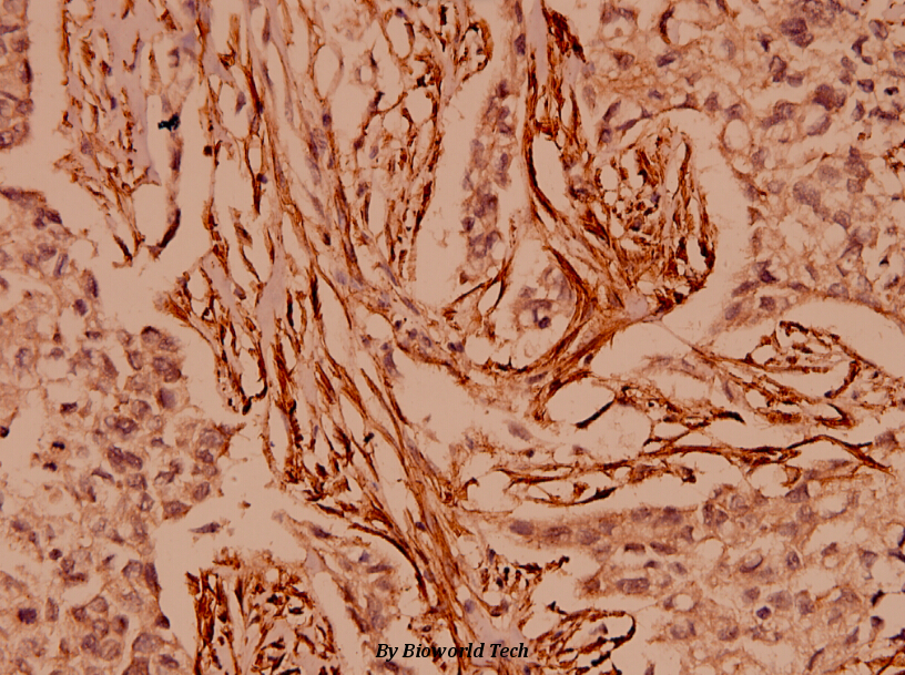 Immunohistochemistry (IHC) analyzes of CARD6 (A2) pAb in paraffin-embedded human breast carcinoma tissue at 1:100.