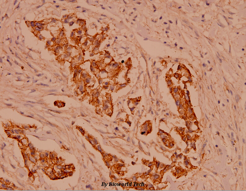 Immunohistochemistry (IHC) analyzes of Catenin-γ (731) pAb in paraffin-embedded human breast carcinoma tissue at 1:100.