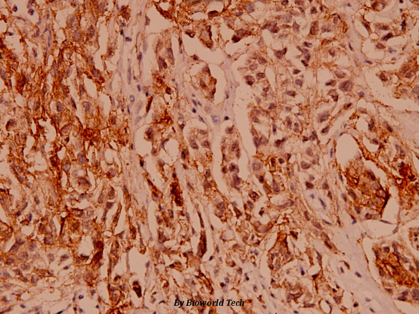Immunohistochemistry (IHC) analyzes of Claudin-1 (R197) pAb in paraffin-embedded human breast carcinoma tissue at 1:100.