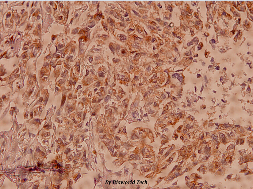 Immunohistochemistry (IHC) analyzes of Claudin-7 (P202) pAb in paraffin-embedded human breast carcinoma tissue at 1:100.