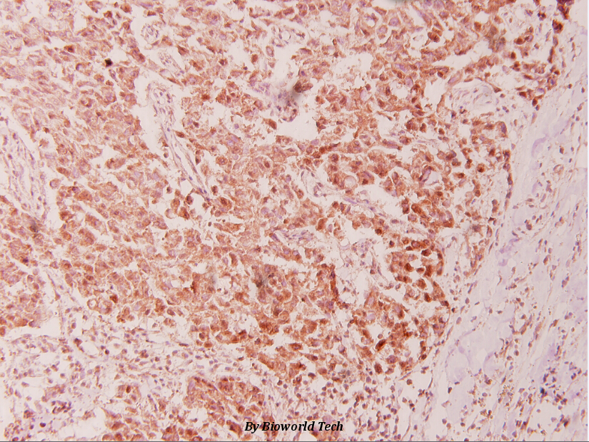 Immunohistochemistry (IHC) analyzes of CSE1L (E2) pAb in paraffin-embedded human breast carcinoma tissue at 1:100.