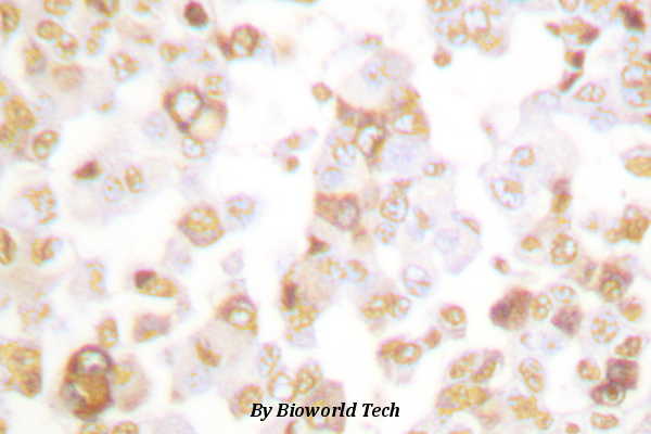 Immunohistochemistry (IHC) analyzes of Cyclin F (I772) pAb in paraffin-embedded human breast carcinoma tissue.