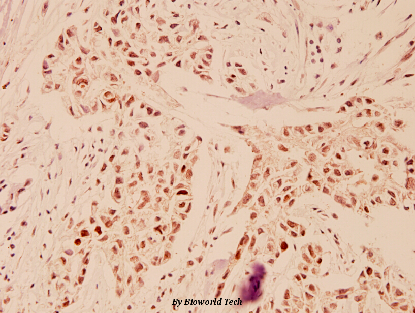 Immunohistochemistry (IHC) analyzes of TFDP1 (V393) pAb in paraffin-embedded human breast carcinoma tissue at 1:100.