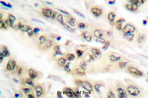 Immunohistochemistry (IHC) analyzes of E2F4/E2F5 (L50/83) pAb in paraffin-embedded human lung carcinoma tissue.