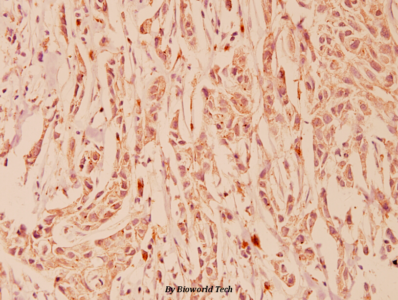 Immunohistochemistry (IHC) analyzes of FGFR1 OP (N371) pAb in paraffin-embedded human breast carcinoma tissue at 1:100.