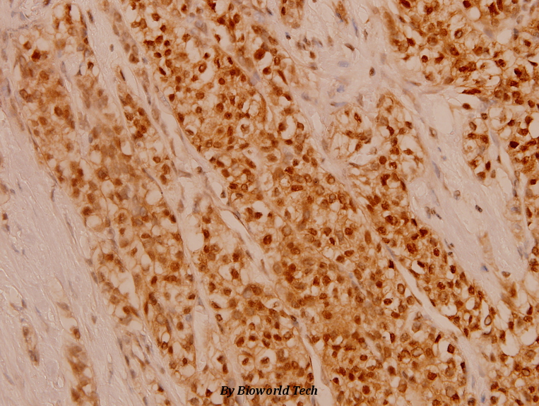 Immunohistochemistry (IHC) analyzes of Fli-1 (R319) pAb in paraffin-embedded human breast carcinoma tissue at 1:100.
