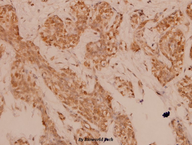 Immunohistochemistry (IHC) analyzes of FOSL2 (S301) pAb in paraffin-embedded human breast carcinoma tissue at 1:100.