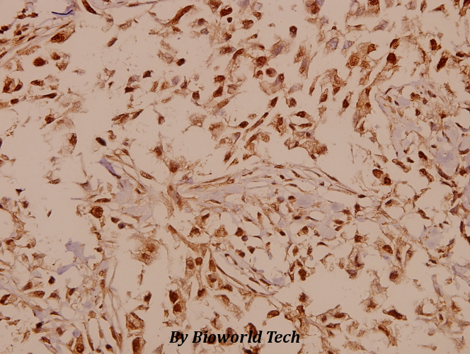 Immunohistochemistry (IHC) analyzes of GABAB R1 (I902) pAb in paraffin-embedded human breast carcinoma tissue at 1:50.