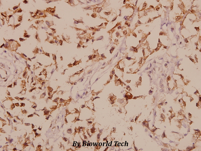 Immunohistochemistry (IHC) analyzes of GABAA Rβ1 (R328) pAb in paraffin-embedded human breast carcinoma tissue at 1:50.