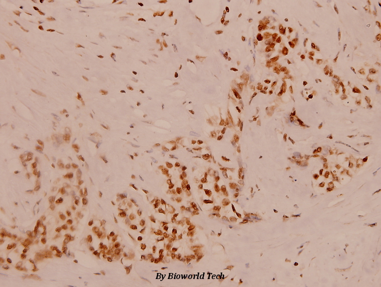 Immunohistochemistry (IHC) analyzes of GANP (E1872) pAb in paraffin-embedded human breast carcinoma tissue at 1:100.