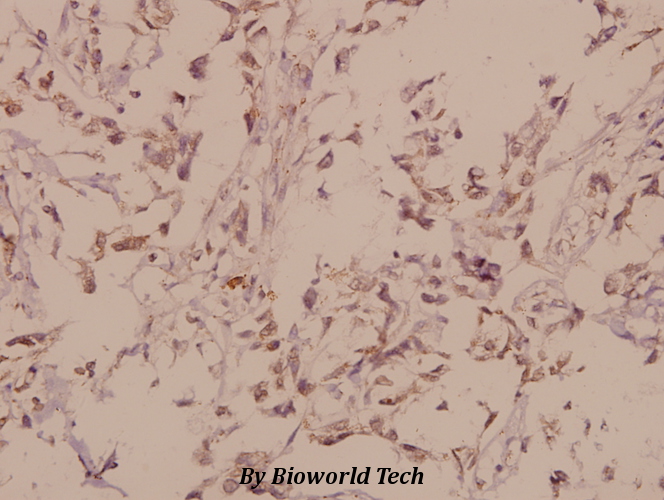 Immunohistochemistry (IHC) analyzes of mGluR-4 (Q875) pAb in paraffin-embedded human breast carcinoma tissue at 1:50.