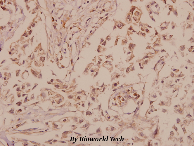 Immunohistochemistry (IHC) analyzes of GluR-5 (L12) pAb in paraffin-embedded human breast carcinoma tissue at 1:50.