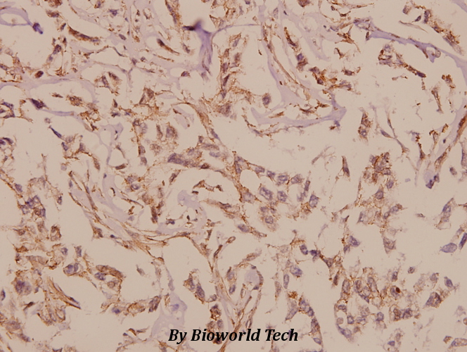 Immunohistochemistry (IHC) analyzes of mGluR-6 (A865) pAb in paraffin-embedded human breast carcinoma tissue at 1:50.