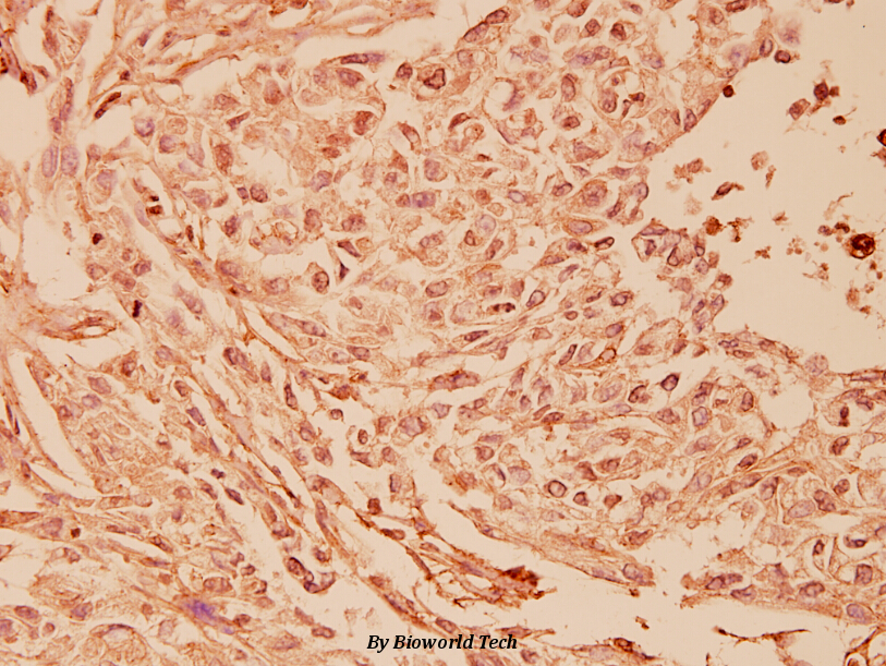 Immunohistochemistry (IHC) analyzes of mGluR-7 (E894) pAb in paraffin-embedded human breast carcinoma tissue at 1:100.