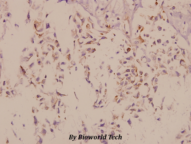 Immunohistochemistry (IHC) analyzes of mGluR-8 (Q871) pAb in paraffin-embedded human breast carcinoma tissue at 1:50.