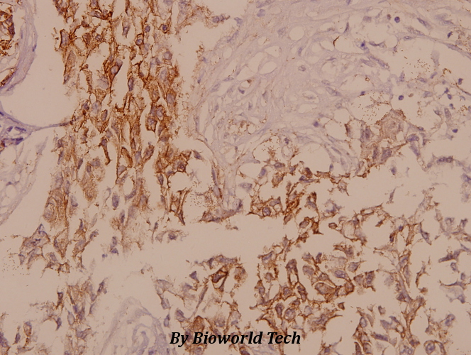 Immunohistochemistry (IHC) analyzes of Glut 1 (G470) pAb in paraffin-embedded human breast carcinoma tissue at 1:50.