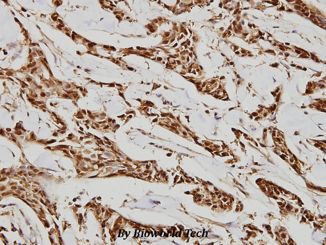 Immunohistochemistry (IHC) analyzes of HDAC 10 (E24) pAb in paraffin-embedded human breast carcinoma tissue at 1:100.