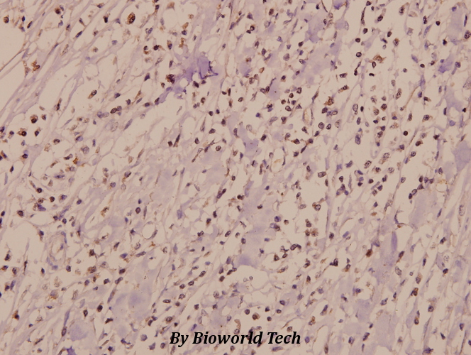 Immunohistochemistry (IHC) analyzes of IL-3Rβ (F587) pAb in paraffin-embedded human breast carcinoma tissue at 1:50.