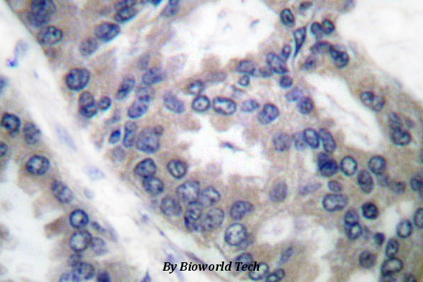 Immunohistochemistry (IHC) analyzes of NOS2 (V1131) pAb in paraffin-embedded human lung carcinoma tissue.