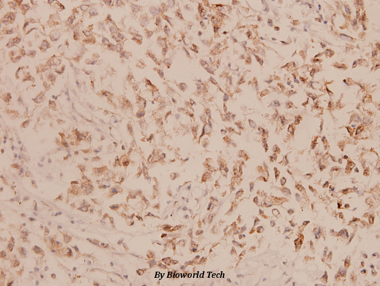 Immunohistochemistry (IHC) analyzes of Involucrin (P568) pAb in paraffin-embedded human breast carcinoma tissue at 1:100.