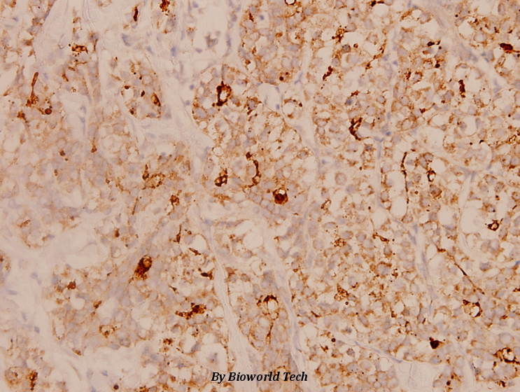 Immunohistochemistry (IHC) analyzes of JAK1 (I1016) pAb in paraffin-embedded human breast carcinoma tissue at 1:100.