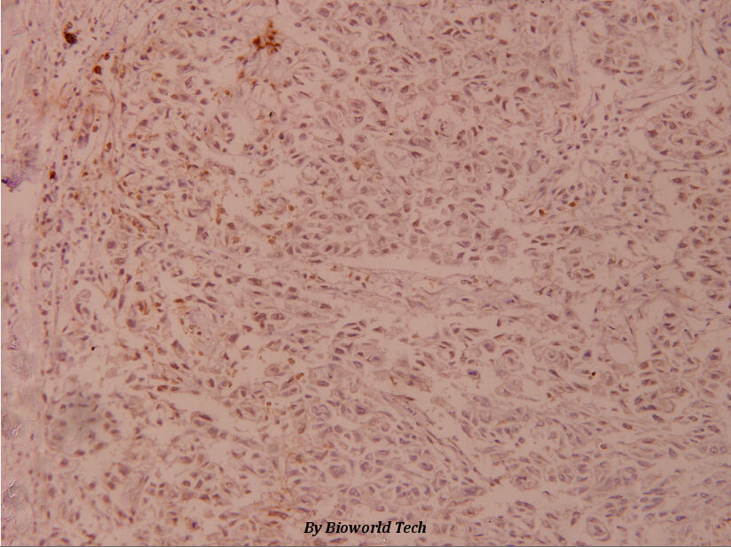 Immunohistochemistry (IHC) analyzes of JunD (V249) pAb in paraffin-embedded human breast carcinoma tissue at 1:100.