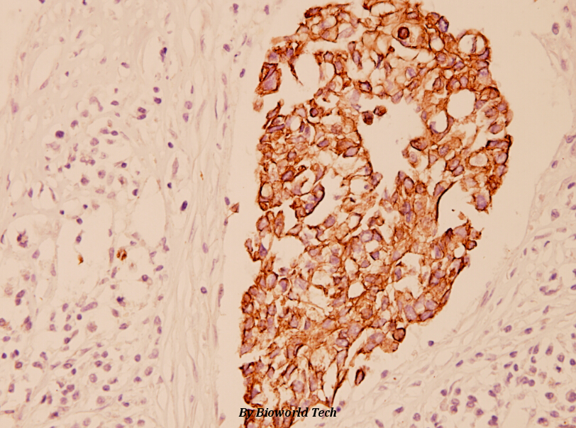 Immunohistochemistry (IHC) analyzes of Cytokeratin 7 (L451) pAb in paraffin-embedded human breast carcinoma tissue at 1:100.