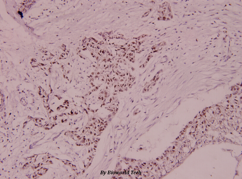 Immunohistochemistry (IHC) analyzes of MCM5 (F51) pAb in paraffin-embedded human breast carcinoma tissue at 1:100.