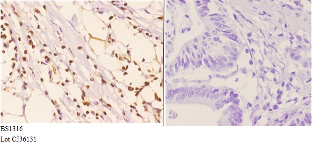 Immunohistochemistry (IHC) analyzes of RXRγ (L200) pAb in paraffin-embeddedhuman colon carcinoma tissue at 1:50.showing nucleus staining. Negative control (the right)Using PBS instead of primary antibody, secondary antibody is Goat Anti-Rabbit IgG-biotin followed by avidin-peroxidase.