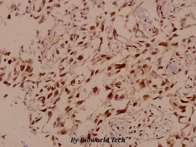 Immunohistochemistry (IHC) analyzes of SMC 1 (S951) pAb in paraffin-embedded human breast carcinoma tissue at 1:50.