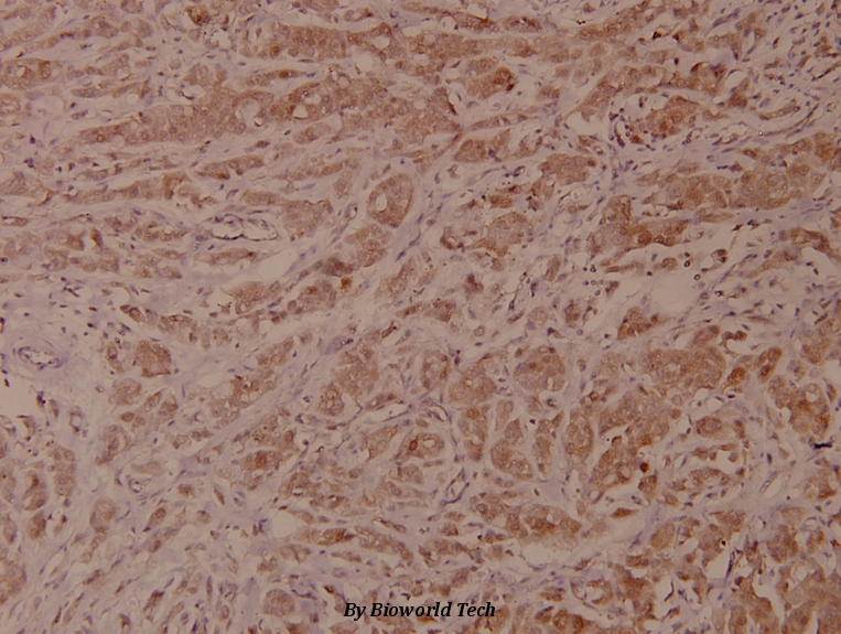 Immunohistochemistry (IHC) analyzes of VaV1 (A168) pAb in paraffin-embedded human breast carcinoma tissue at 1:100.