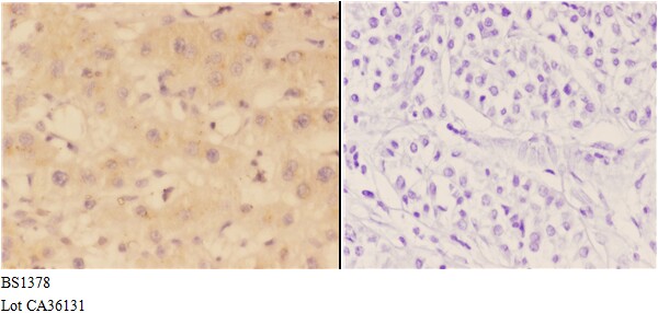 Immunohistochemistry (IHC) analyzes of ACCα (H74) pAb bin paraffin-embedded human liver carcinoma tissue at 1:50,showing cytoplasmic staining.Negative control (the right)Using PBS instead of primary antibody, secondary antibody is Goat Anti-Rabbit IgG-biotin followed by avidin-peroxidase.