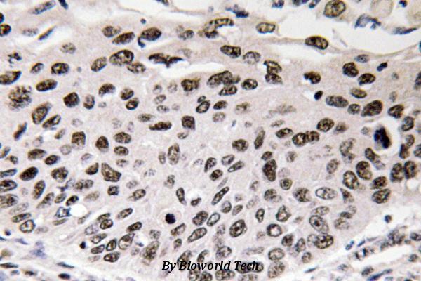 Immunohistochemistry (IHC) analyzes of Cyclin D3 (G277) pAb in paraffin-embedded human lung carcinoma tissue.