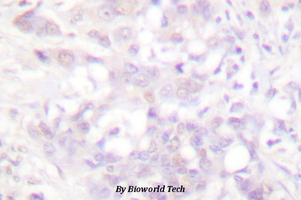 Immunohistochemistry (IHC) analyzes of POLR2A (P1613) pAb in paraffin-embedded human breast carcinoma tissue.