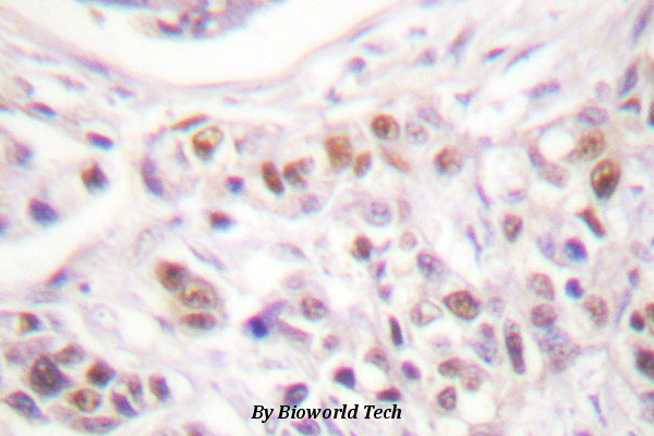 Immunohistochemistry (IHC) analyzes of Rad17 (A639) pAb in paraffin-embedded human breast carcinoma tissue.