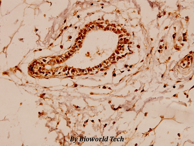 Immunohistochemistry (IHC) analyzes of Adducin α (K439) pAb in paraffin-embedded human breast carcinoma tissue at 1:100.