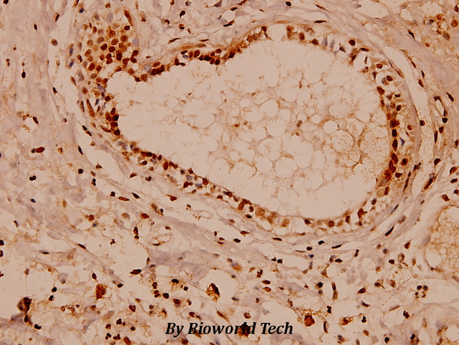 Immunohistochemistry (IHC) analyzes of Na+/K+-ATPase α1 (Y10) pAb in paraffin-embedded human breast carcinoma tissue at 1:100.