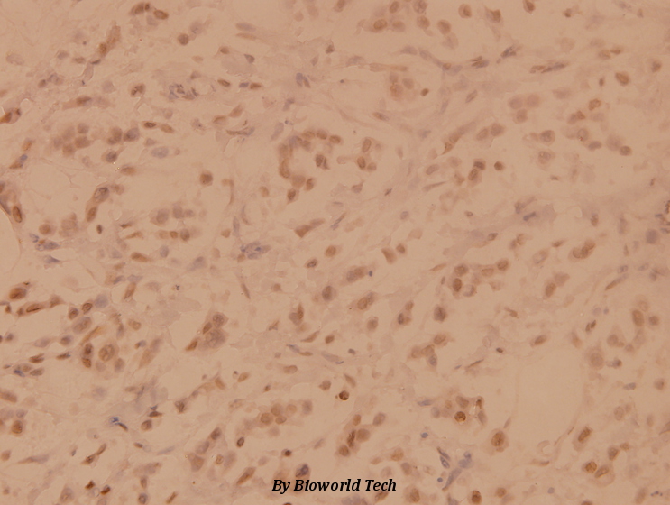 Immunohistochemistry (IHC) analyzes of SENP3 (Y24) pAb in paraffin-embedded human breast carcinoma tissue at 1:100.