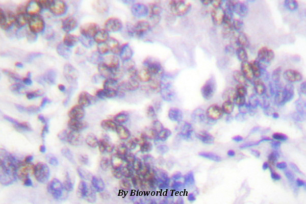 Immunohistochemistry (IHC) analyzes of SENP6 (K1077) pAb in paraffin-embedded human lung carcinoma tissue.